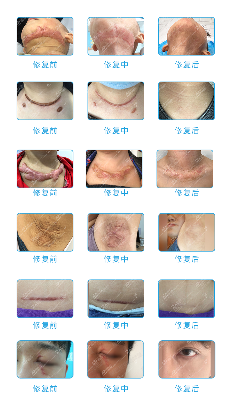 7-康巴克疤痕抑菌液产品案例.png