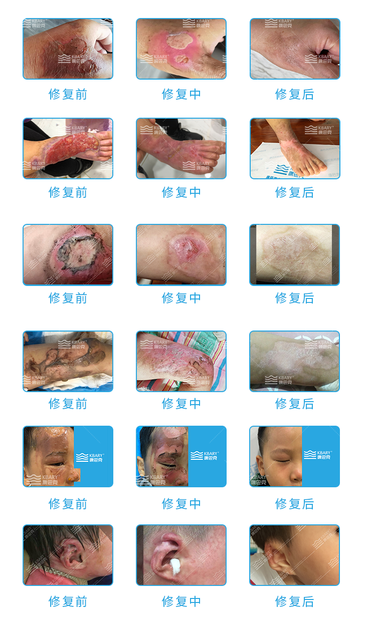 4-素玉疤痕抑菌膏产品案例.png